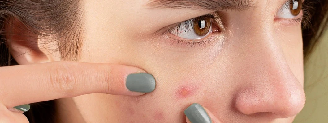 Kako se znebiti aken in mozoljev: učinkovite rešitve za čisto kožo