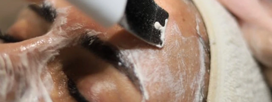 Akne in mozolji: vzroki in učinkovita nega kože